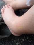 One swollen ankle... (Chloe's)